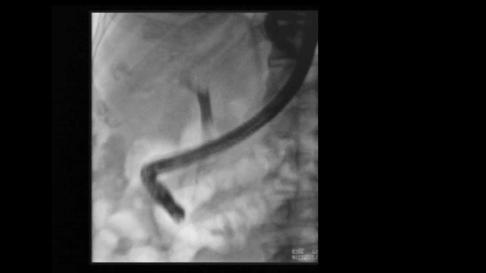 ゼメックス製品を用いたERCP A to Z| ケースレポート : 消化器