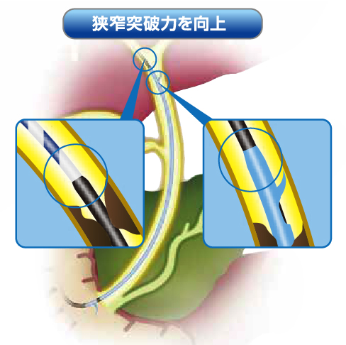 胆道ドレナージへの5つの特長